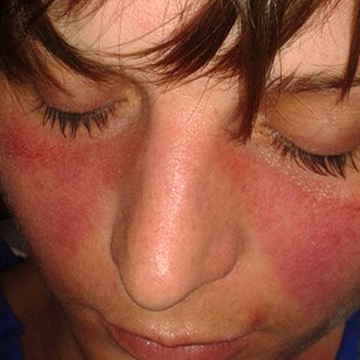 <p>Autoimmune disorder with periods of remission</p><p>Mucosa and skin ulcerations</p><p>"Butterfly" rash found on face</p>