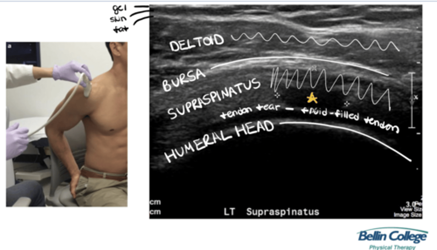 <p>Gel --> skin --> fat --> deltoid --> bursa --> supraspinatus w/ a fluid-filled pocket --> humeral head</p>