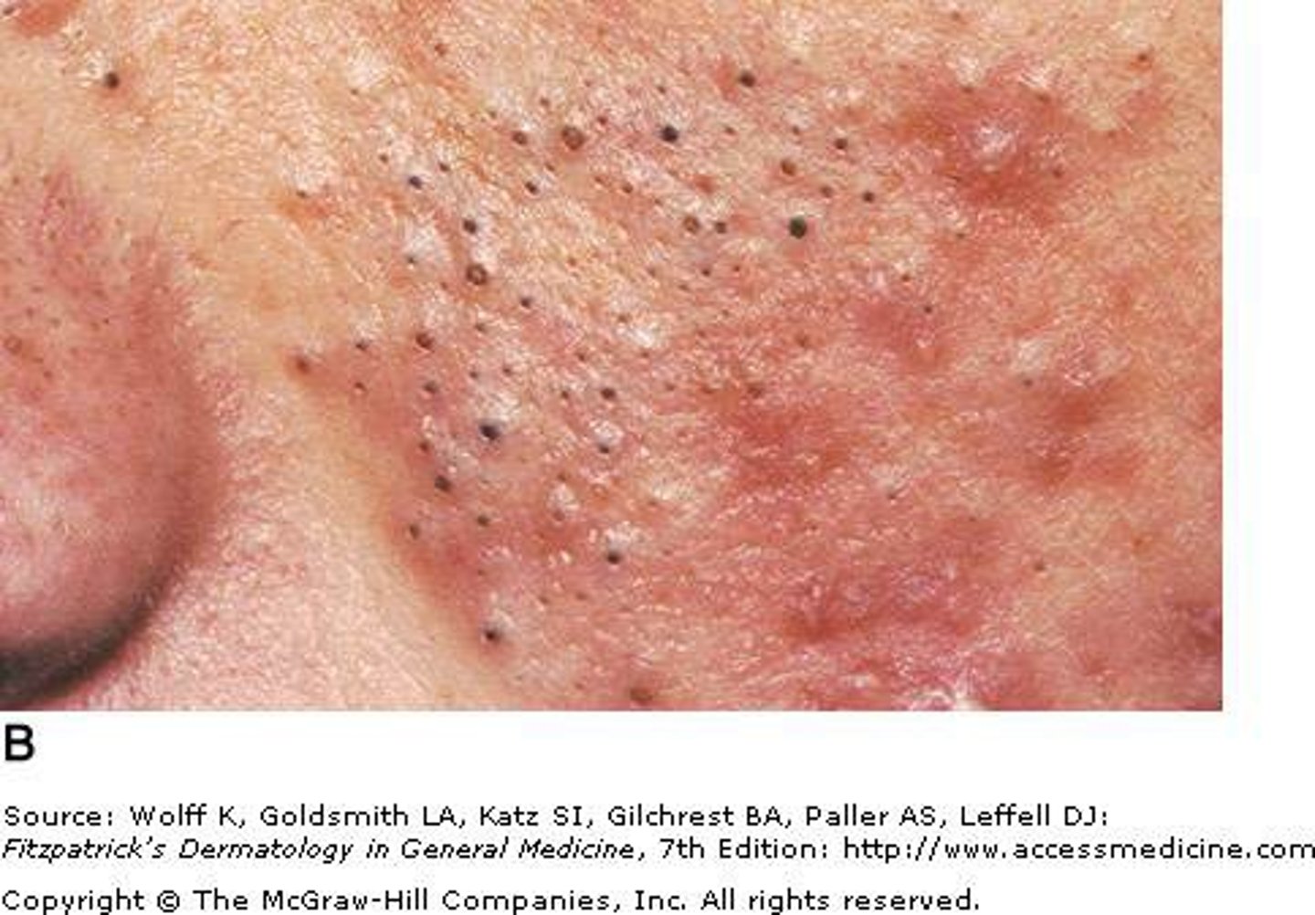 <p>Blackhead open at the surface and exposed to air</p>