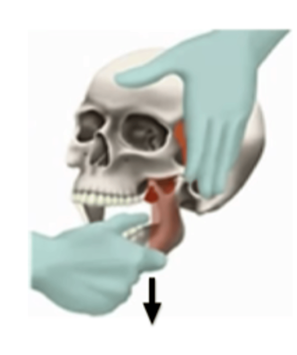<p>- head stabilized against PT</p><p>- thumb placed intra-orally on bottom molars</p><p>- hand under chin serving as pivot point</p><p>- gently apply downward force</p>