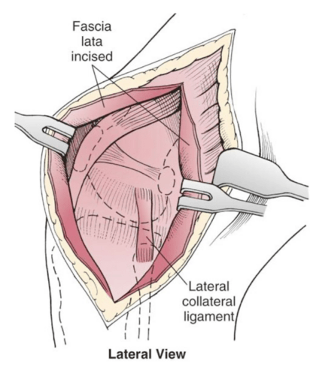 <p>injuries to M/L collateral lig usually occur w/ ____ and typically are the result of multiple ligament injuries from severe trauma</p>