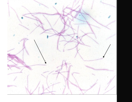 <ul><li><p>GNB pleomorphic</p><ul><li><p>fusiform, tapered ends</p></li></ul></li><li><p>produce butyric acid and propionic acid</p></li><li><p>mix bacterial infection</p></li><li><p>also neck, breast and axillaries infections</p></li><li><p>male GT and perianal infections</p></li><li><p><em>F. necrophorum, F. nucleatum, F. novum</em></p></li></ul><p></p>