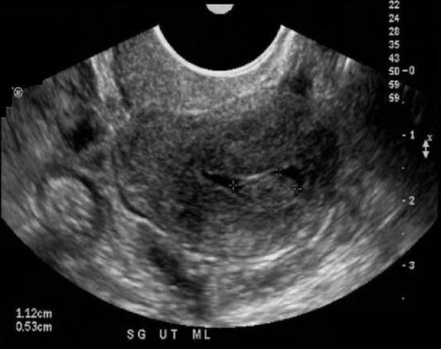 <p>a) a fibroid forming in endometrial canal</p><p>b) mass of ectopic endometrium surrounded by a small amount of fluid in the endometrial canal due to endometriosis</p><p>c) a blighted ovum w/fetal pole + diminishing GS</p><p>d) an endometrial polyp + small amount of fluid in the endometrial canal </p>