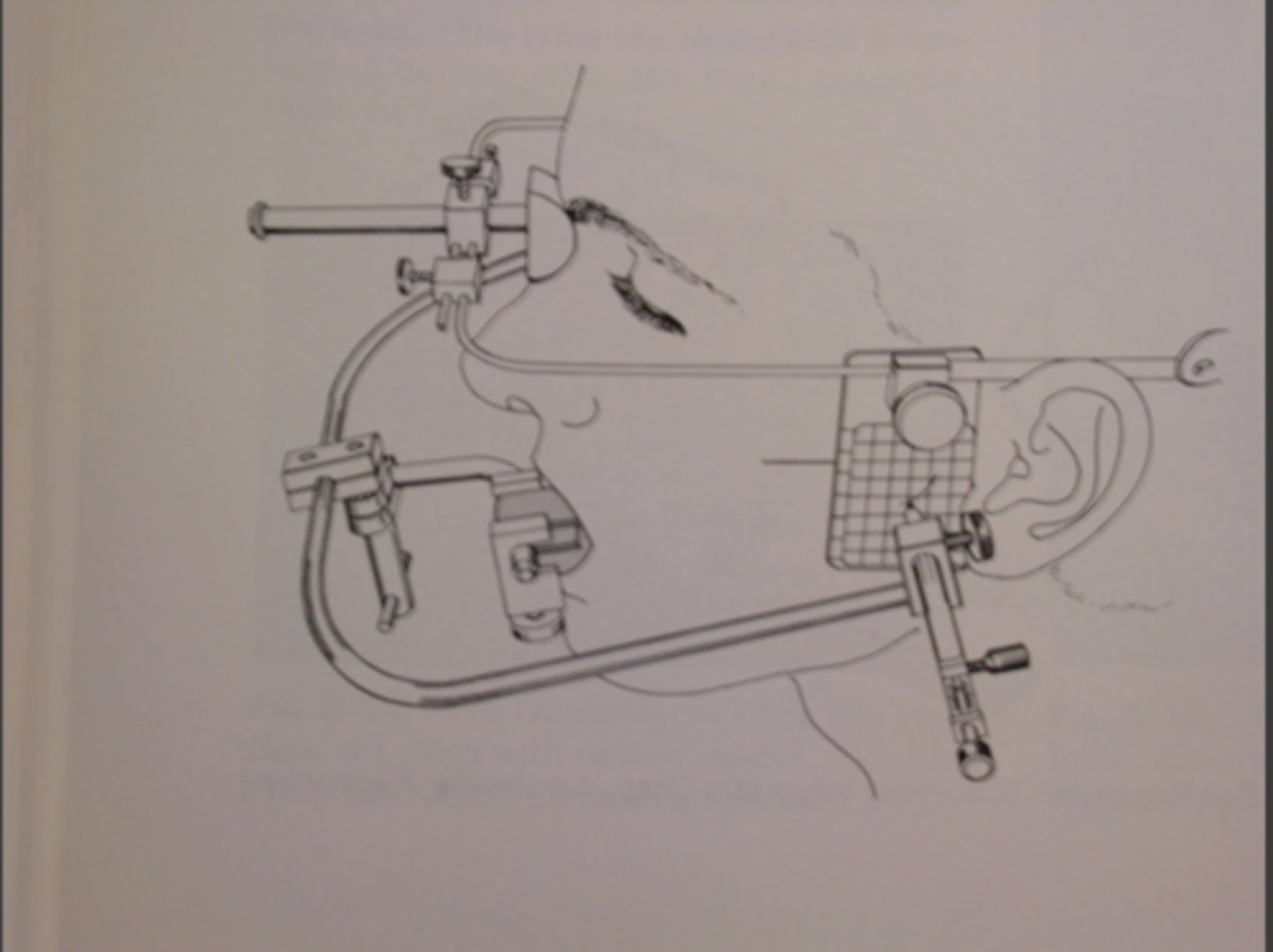 <p>Precisely locates the actual hinge axis; more accurate but time-consuming.</p>