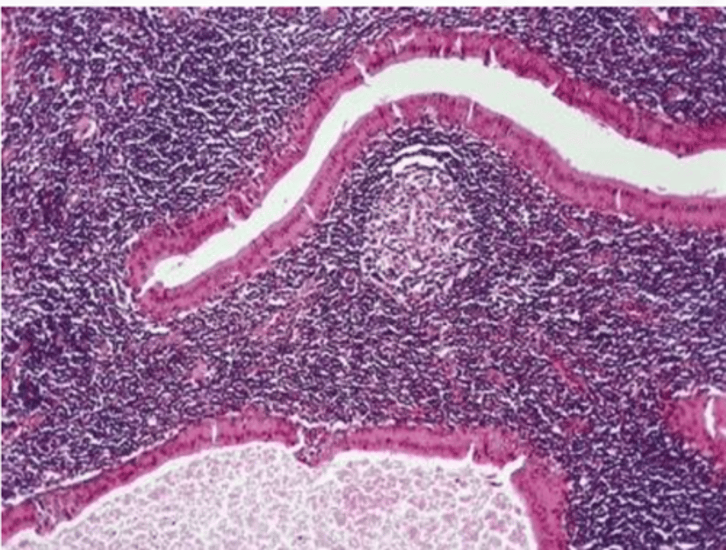 <p>-Cyst lined by uniform rows of oncocytic cells</p><p>-The lining is papillary in appearance</p><p>-The cyst wall is composed of abundant lymphocytes</p>