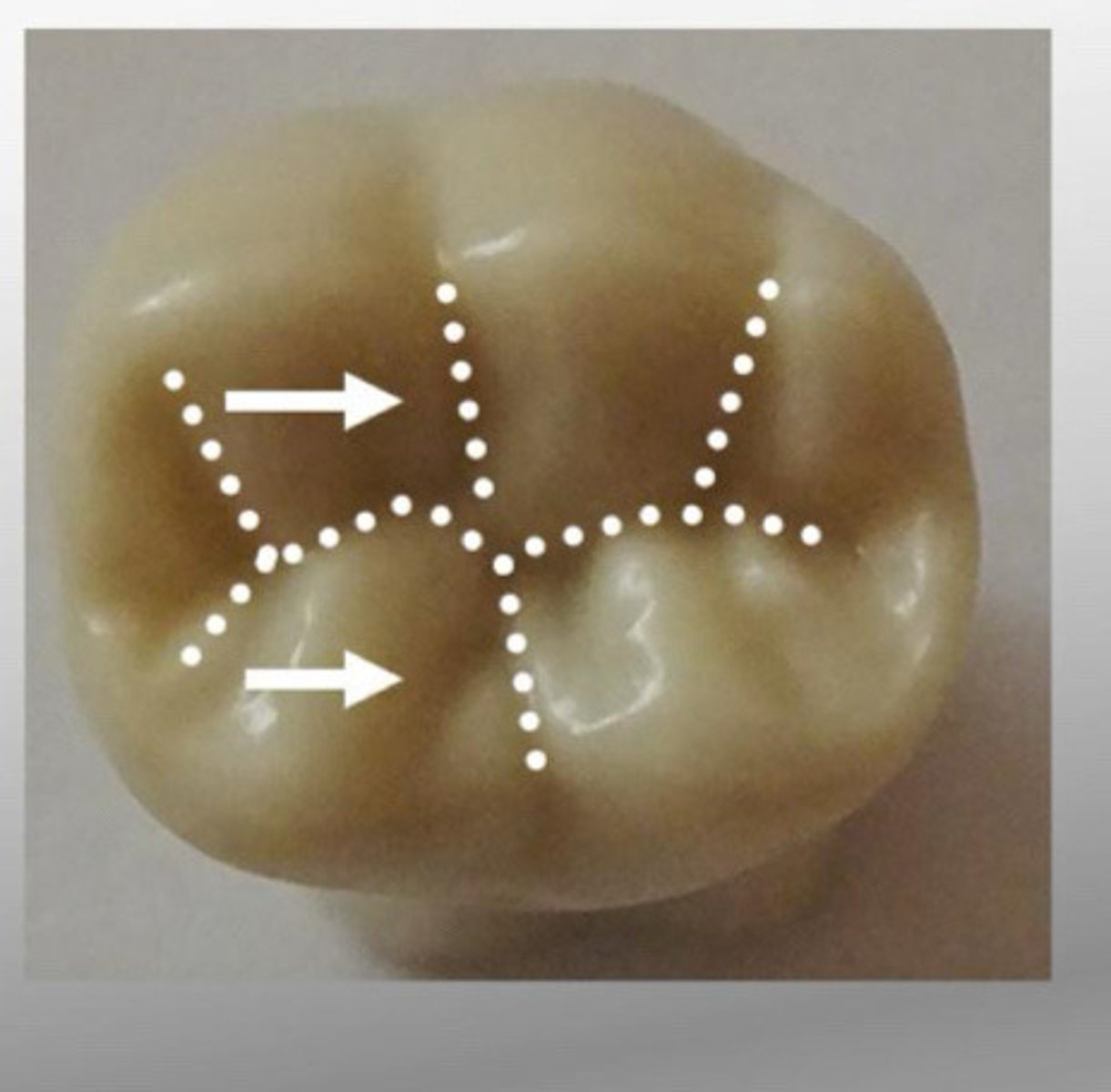 <p>sharply defined, narrow, linear depression formed during tooth development separating lobes or major portion of a tooth</p>