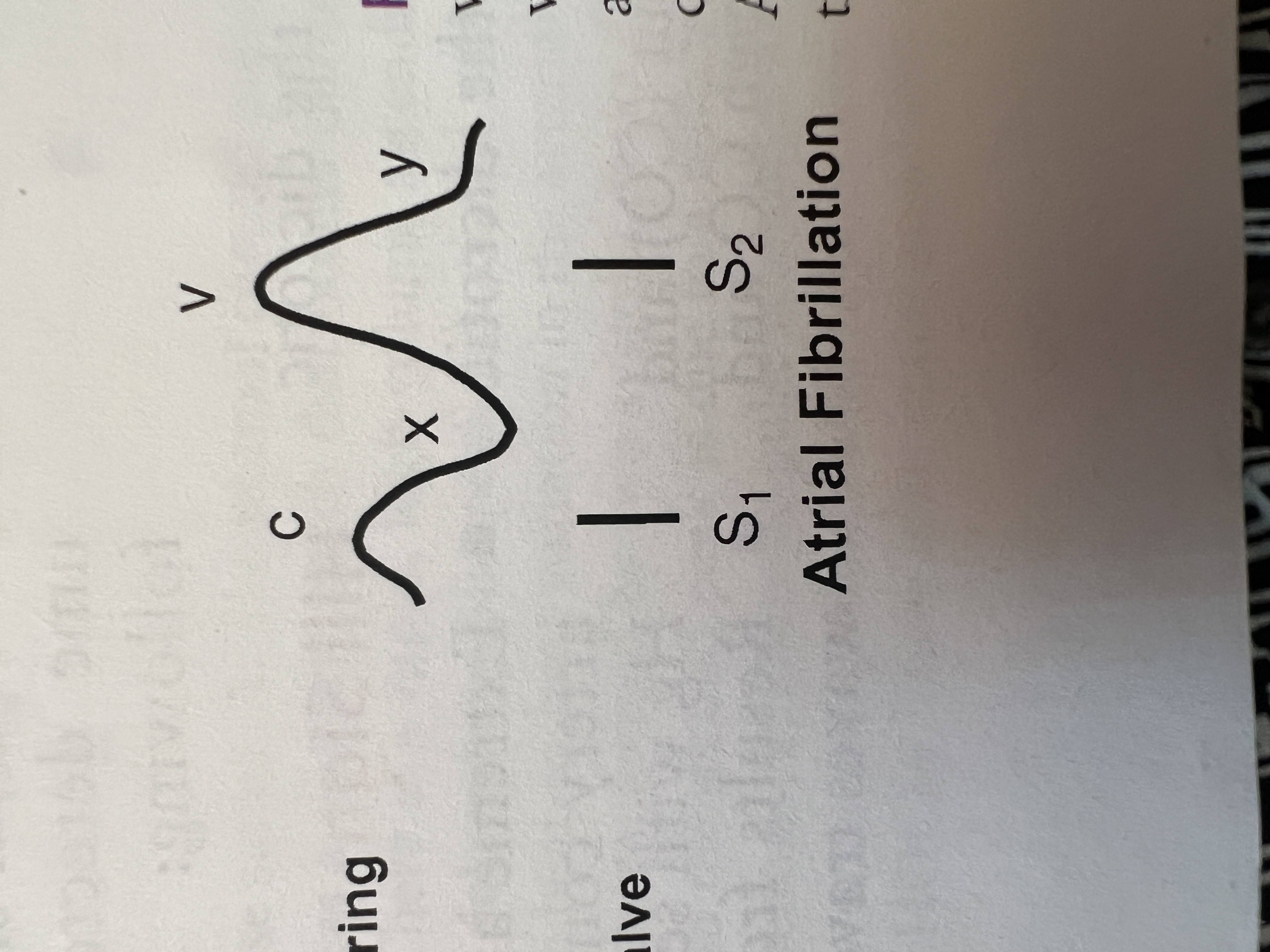 <p>Which wave is lost with atrial fibrillation?</p>