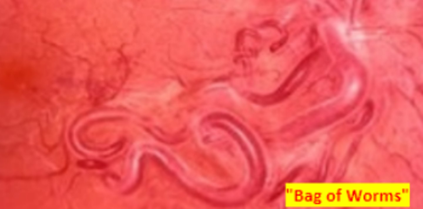 <p>a congenital advanced type of arteriovenous malformation resulting in a direct communication between arteries and veins with no capillary beds occurring unilaterally. Can be independent or occur alongside Wyburn Mason syndrome. Vessel occlusion may occur due to compromise of blood flow. Effect on vision is variable. Refer for systemic and neuro consult.</p>