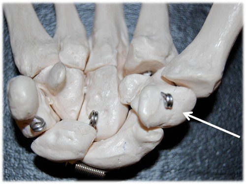 Name this specific bone of the hand (anterior view).