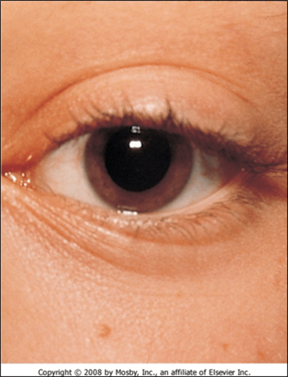 <p>Lines from inner canthus that traverse the lower lid margin -- Indicates allergic rhinitis</p>