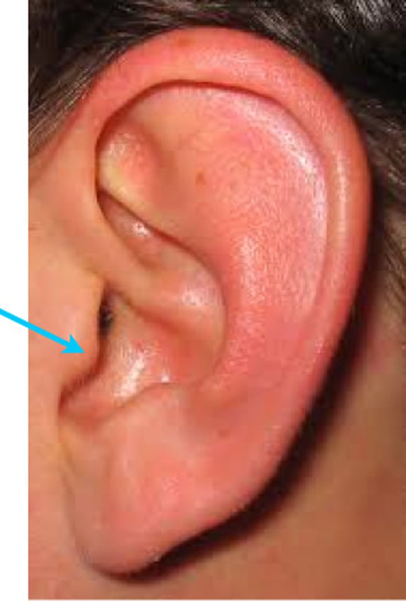 <p>A) Tragus</p><p>pg. 406: tragus, the small cartilaginous flap that covers the opening of the ear.</p>