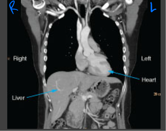 <p>Viewed the same way that most radiographs are viewed: the images are oriented as though the patient is looking at you </p>