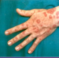 <p>what is the description of this skin lesion </p>