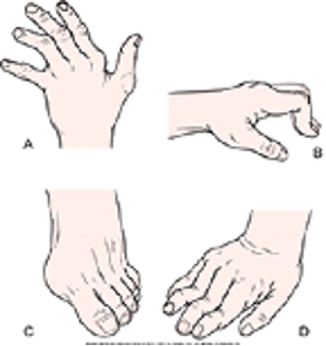 <p>ANS: A. Sleep disturbances</p><p>B. Multiple tender points</p><p>E. Widespread bilateral, burning musculoskeletal pain</p><p>These symptoms are commonly described by patients with fibromyalgia. Cardiac involvement and joint inflammation are not typical of fibromyalgia.</p>