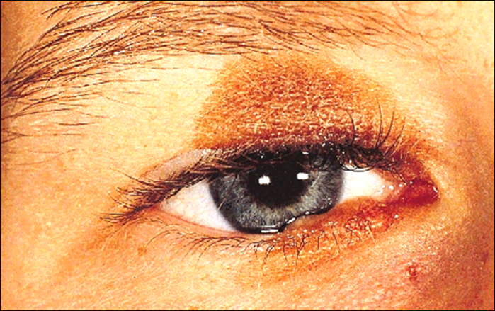 kissing naevus - develops in-utero before the eyelid fissure is formed