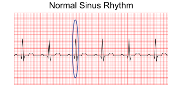 <p><span><span>Which interval, complex, or segment is circled in the EKG?</span></span></p>