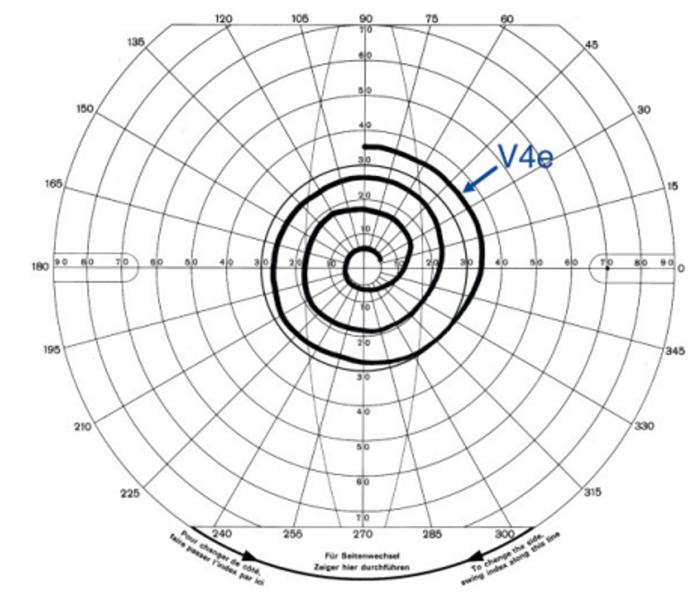 <p>If Goldmann perimetry results in a spiral shaped visual field, this suggests a ______ visual field defect</p>