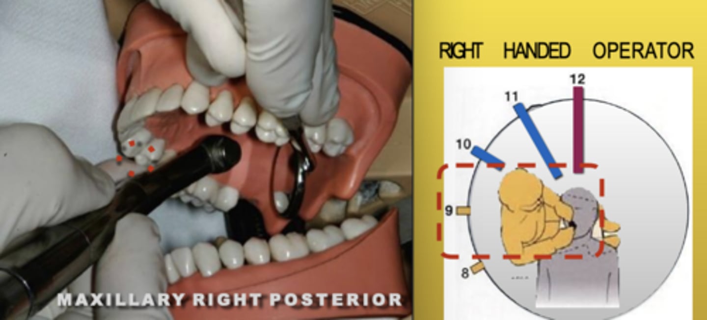 <p>Zone: 9</p><p>Vision: Direct</p><p>Patient's Head: Right</p><p>Fulcrum: Max Right Posteriors (B) or (O)</p>
