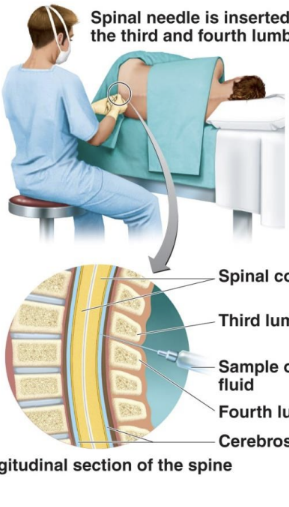 <p><strong>Cerebrospinal fluid (CSF)</strong> obtained via lumbar puncture.</p><p>to confirm CSF analysis, Gram stain, latex agglutination test, culture. (CSF appears cloudy in bacterial infections) are used. </p>