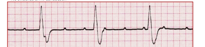 <p>2nd degree AV block Type 2</p>