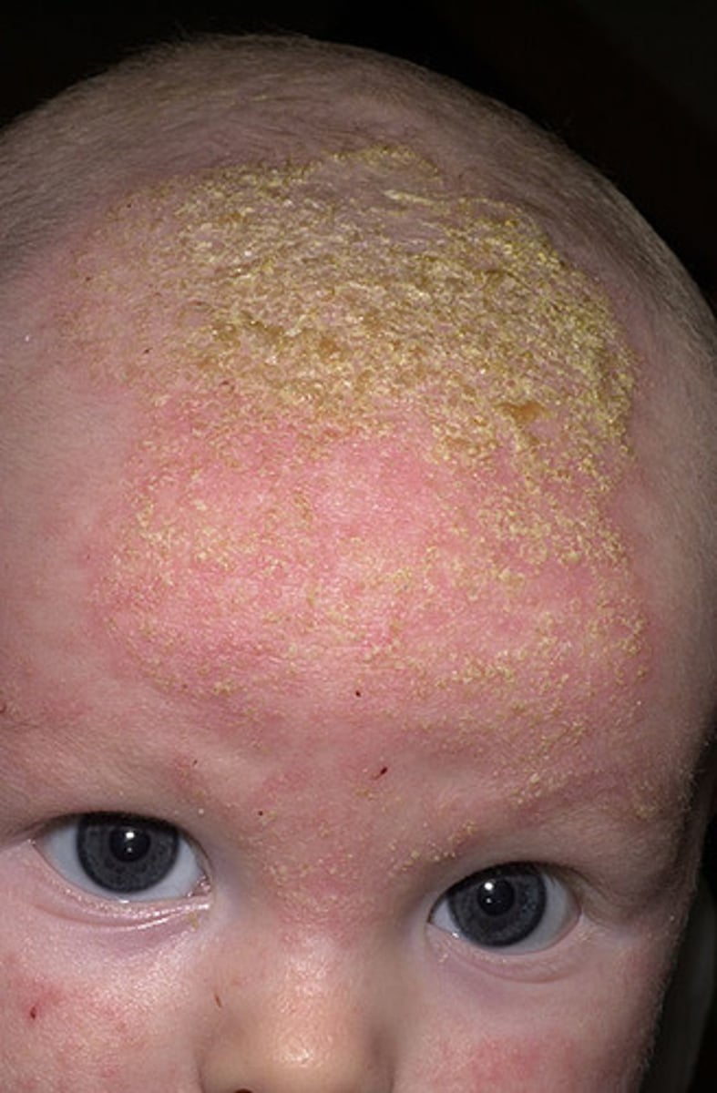 <p>in the scalp, it is called dandruff</p>