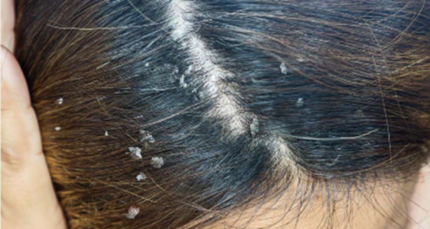 <p>¿lesión?</p><p>¿primaria o secundaria?</p>