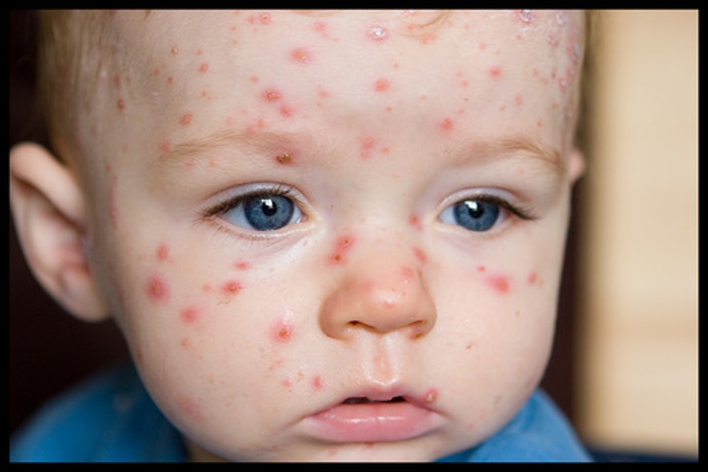 <p>chickenpox</p>