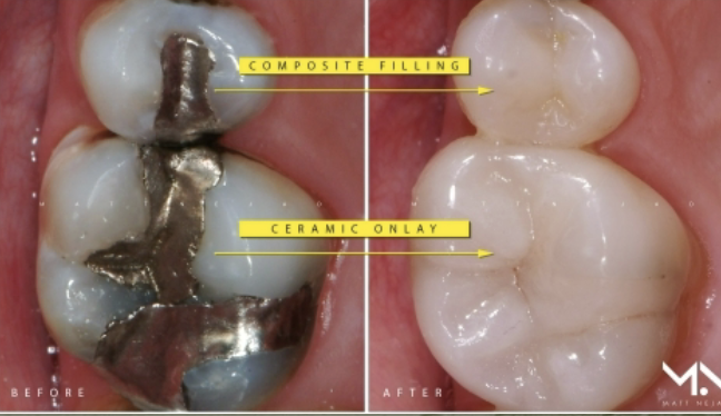 <p>Exogenous Intrinsic Stains: Restorative Materials </p>