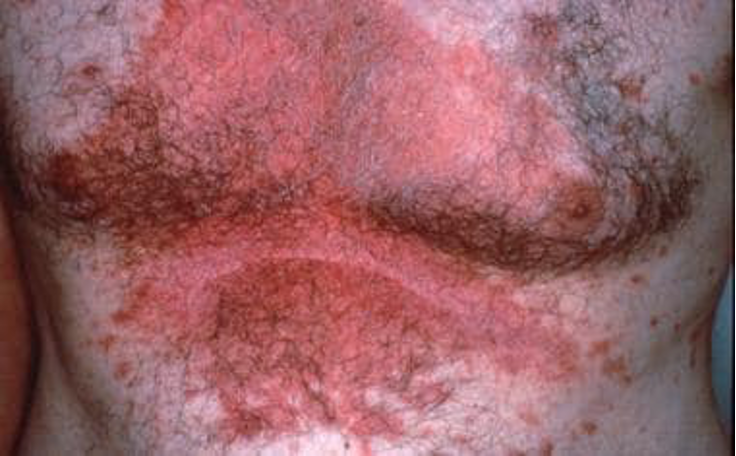 <p>What condition?</p><ul><li><p><strong> sebum-rich areas</strong> of scalp, face, trunk, intertriginous</p></li><li><p>well demarcated, pruritic erythematous plaques w/ <strong>greasy appearing yellow scales</strong></p></li><li><p>ranges from scalp dandruff (pityriasis sicca) to widespread</p></li><li><p>biphasic: infants 2-12 wks (cradle cap) and 4th decade</p></li><li><p>unknown cause but has been linked to malassezia furfur colonization</p></li></ul><p></p>