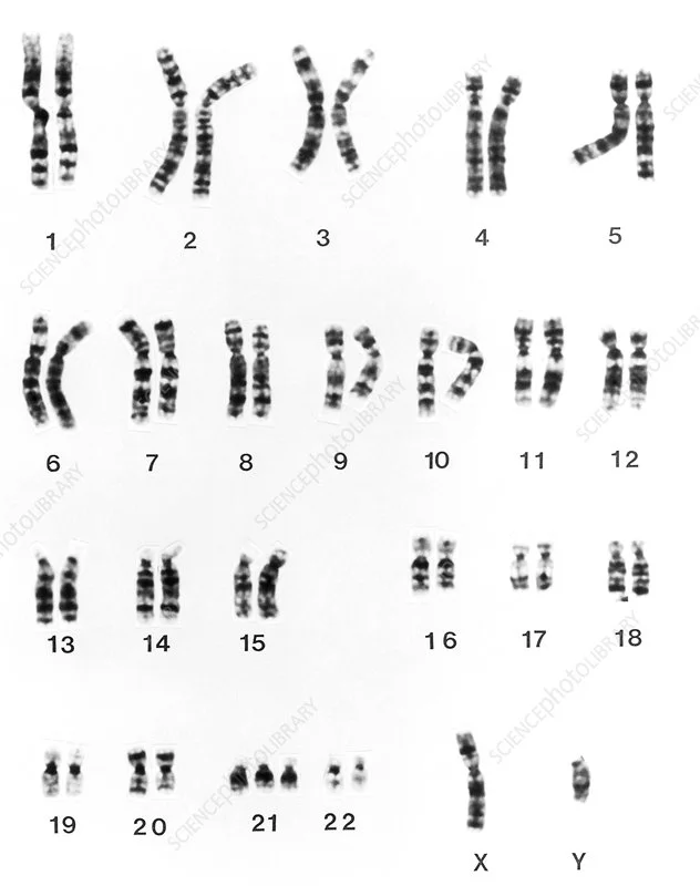 The correct notation for theis karyotype is…