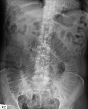 <p>Ileus</p>