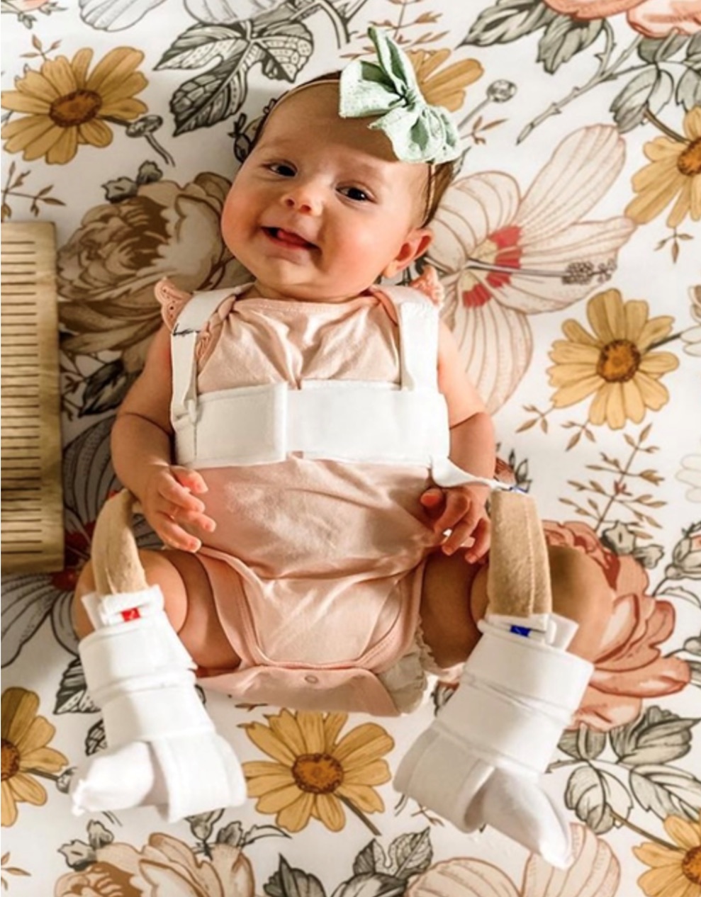 <p>it is a <span><span>harness used for developmental dysplasia of the hip that</span></span></p><ul><li><p>used in newborns to around 6 months of age</p></li></ul><p></p>