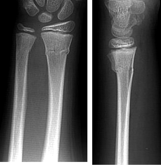 <p>what type of fracture is this?</p>