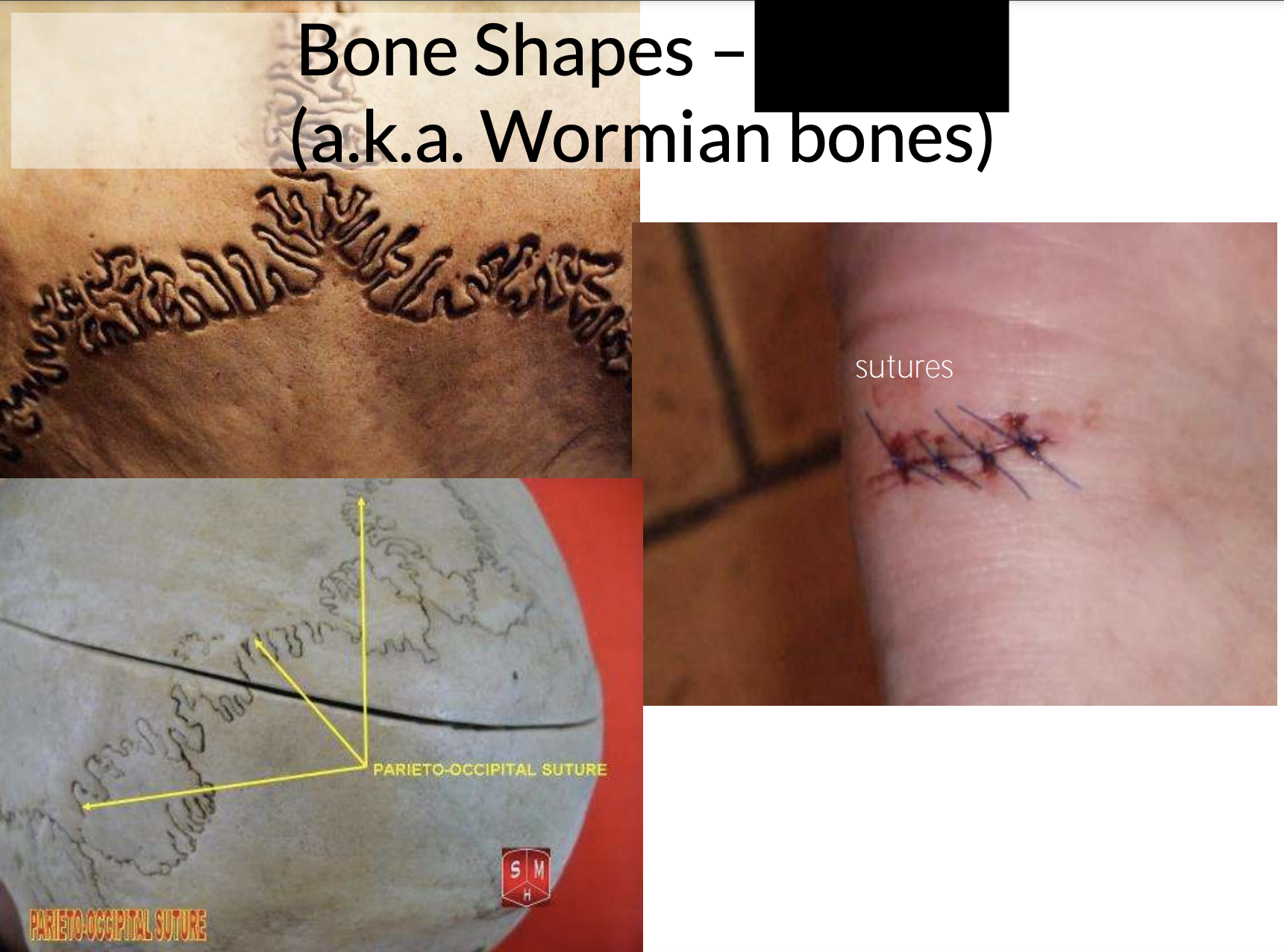 What bone shape is this?