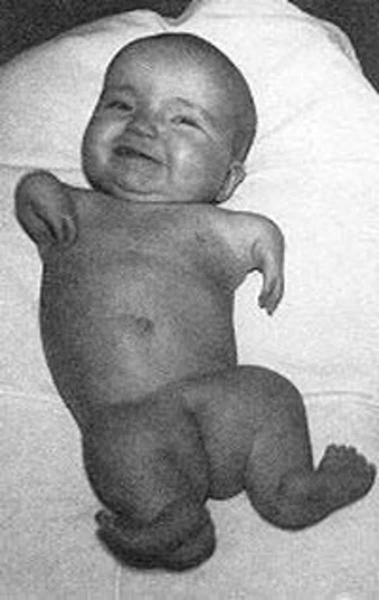 <p>Was introduced in the 1950s as a safe sleeping pill. It led to many thousands of babies being born with malformed limbs and other issues</p>