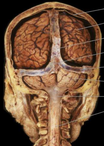 <ul><li><p>bone (skull verta)</p></li><li><p>meninges&nbsp;</p></li><li><p>cerebrospinal fluid (found in the gap between the brain and the skull)</p></li></ul><p></p>