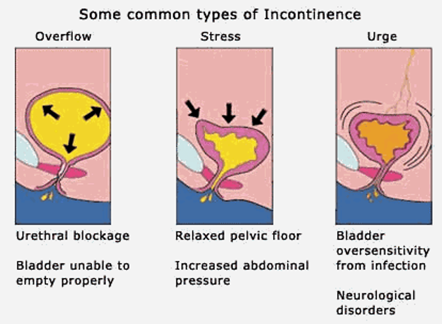 <p>Inability to control urinary functions</p>