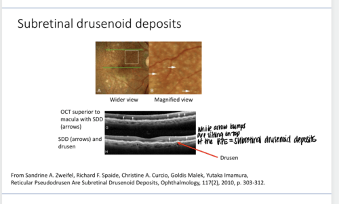 <p>Does Subretinal drusenoid deposits being present change your management plan for a patient?</p>
