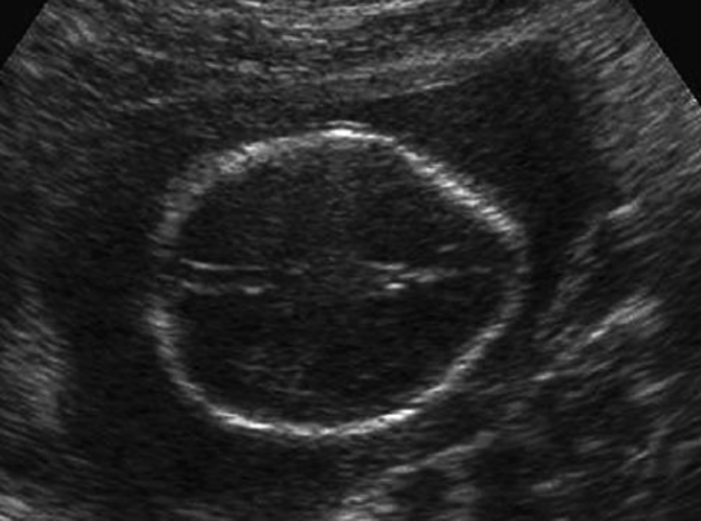 <p>Sunken frontal bones</p>