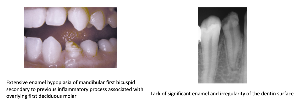 <ul><li><p class="p1">Extensive enamel hypoplasia</p></li><li><p class="p1">Lack of significant enamel</p></li><li><p class="p1">Irregular dentin surface</p></li></ul><p></p>