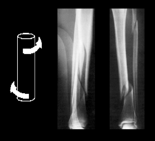 <p>faster!</p><p>more surface area and less soft tissue damage → low load injury</p>