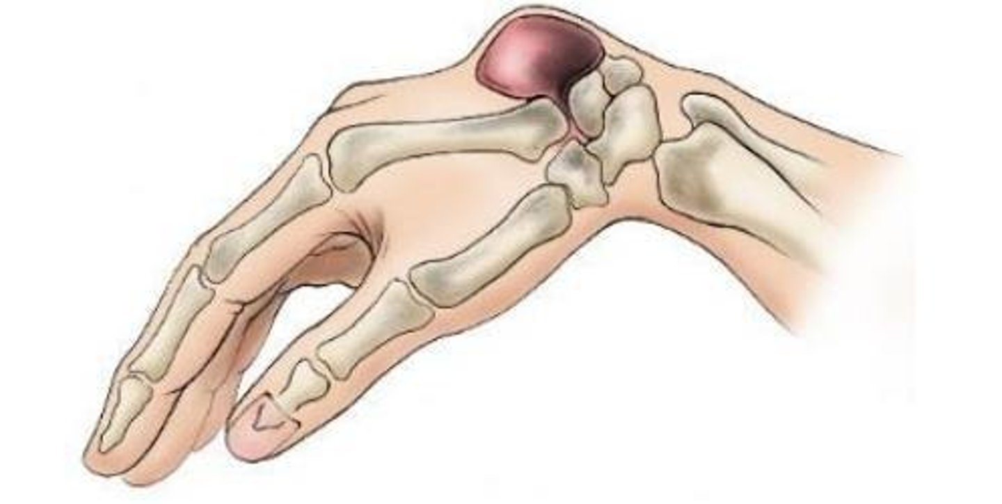 <p>Aka the "Bible bump"</p><p>Multifactorial pathogenesis: tissue stress, degeneration, underlying joint conditions</p><p>Originate from the dorsal wrist joint capsule fibers or dorsal fibers of the SL ligament</p><p>Presentation: Dorsal wrist pain when weightbearing in wrist extension</p>
