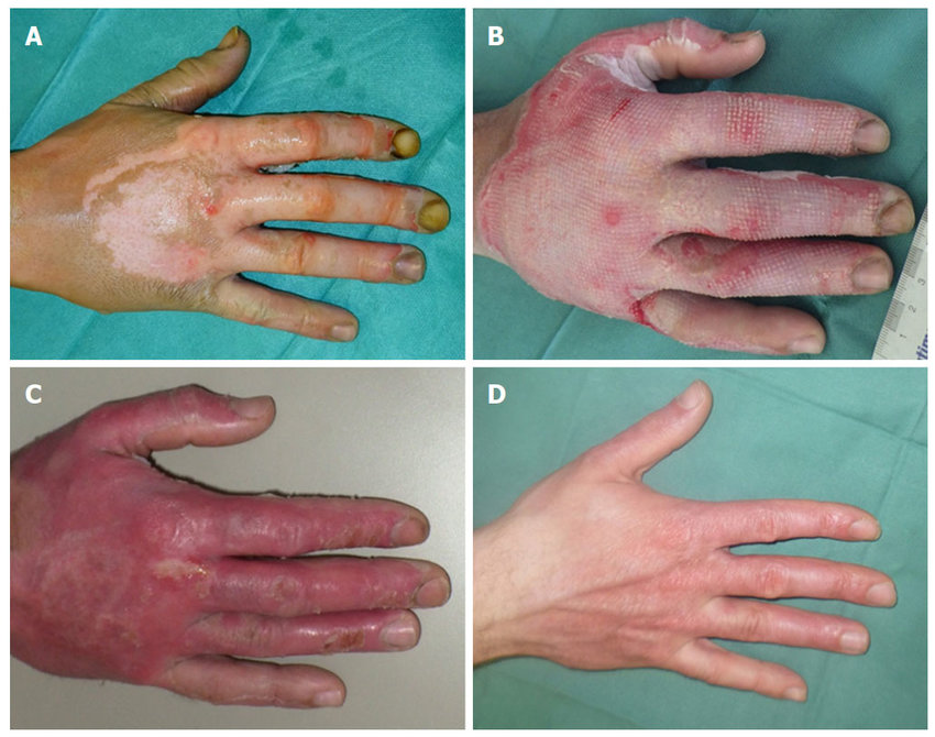 <ul><li><p><span><strong><mark data-color="blue" style="background-color: blue; color: inherit">epidermis &amp; severe damage to dermis, </mark></strong><mark data-color="blue" style="background-color: blue; color: inherit">hair follicles, and sweat glands</mark></span></p></li><li><p style="text-align: left"><span><strong><mark data-color="purple" style="background-color: purple; color: inherit">PRESENTS</mark></strong>:</span> <strong>blotchy</strong>, large pink blisters, <strong>mottled</strong> white, pink, to cherry red; damage to <strong>BV</strong>'s; <strong>painful</strong></p></li><li><p style="text-align: left"><span><strong><mark data-color="purple" style="background-color: purple; color: inherit">OUTCOME</mark></strong>:</span> <strong>3-5 weeks to heal (21-35 days)</strong>; <strong>scarring</strong> increased; often <strong>grafted</strong></p></li></ul><p style="text-align: left"><span><strong><mark data-color="purple" style="background-color: purple; color: inherit">EX</mark></strong>:</span> immersion scalds, flames</p>
