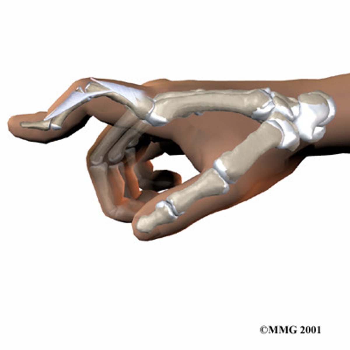 <p>- rupture of central slip of extensor tendon at middle phalanx</p><p>- flexion of PIP and extension of DIP</p><p>- looks like holding a pin hard</p>