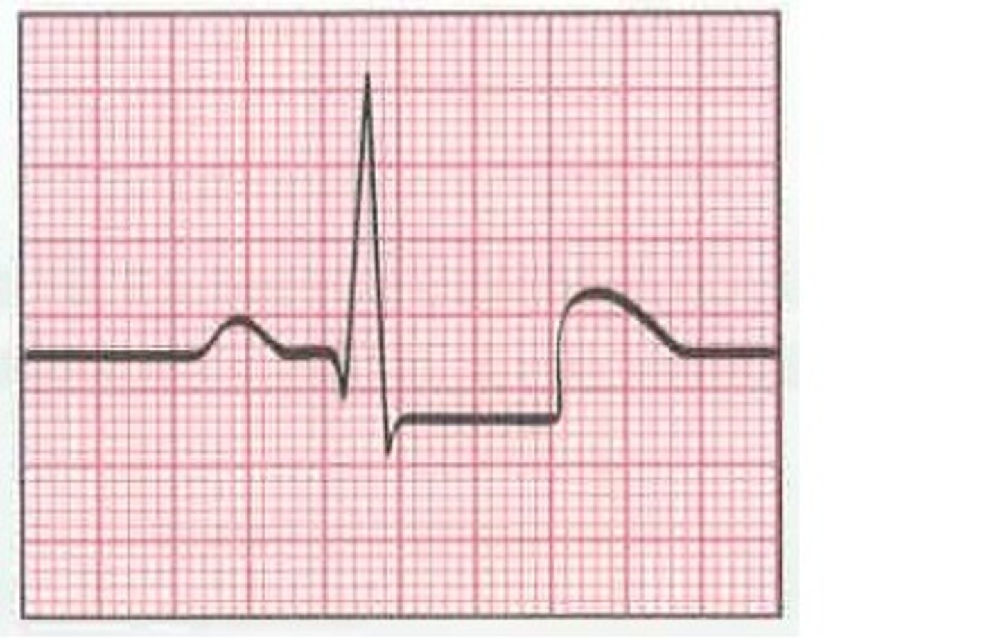 <p>what would the EKG of one with symptomatic stable angina look like?</p>