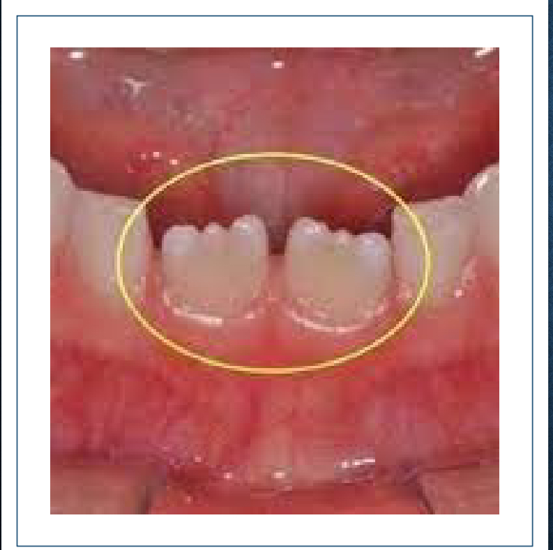 <p>extensions of three labial developmental lobes</p>