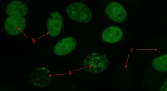 <p>Identify the anti-nuclear antibody (ANA) pattern in this microscopic image.</p><p>A. Homogeneous </p><p>B. Speckled </p><p>C. Anticentromere antibody </p><p>D. Anti-Ro (SS-A) (alcohol fixation)</p>