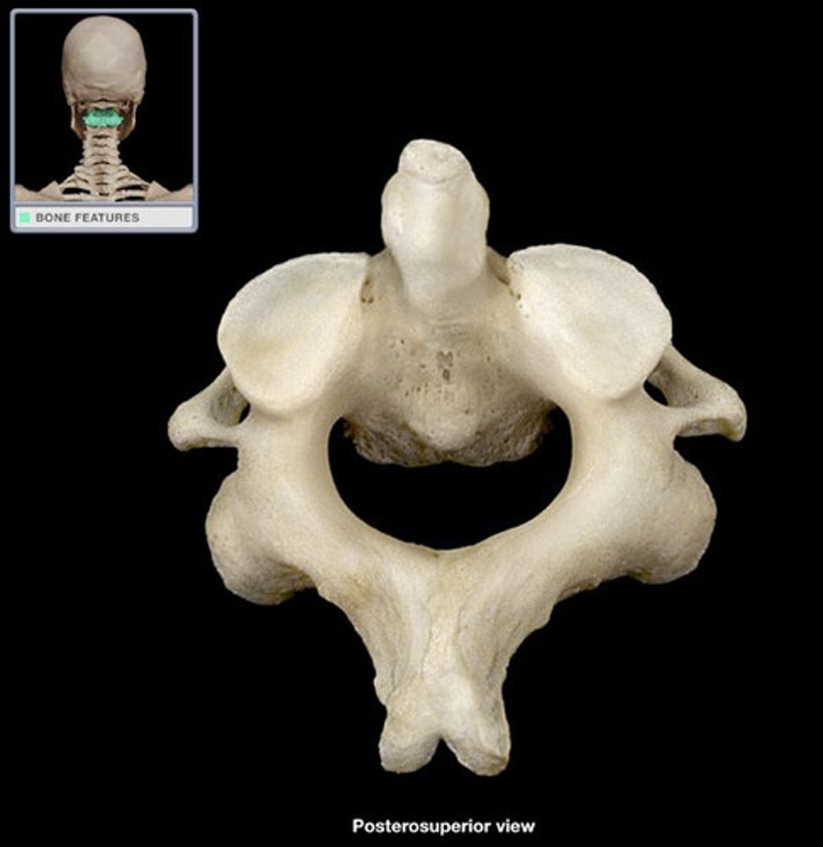 <p>- has spinous process, vertebral arch, vertebral body, superior articular process, superior articular facet, transverse process, transverse foramen</p><p>- has a pedicle between the superior articular facet and vertebral body</p><p>- contains the dens/ordontoid process which articulates with C1</p>