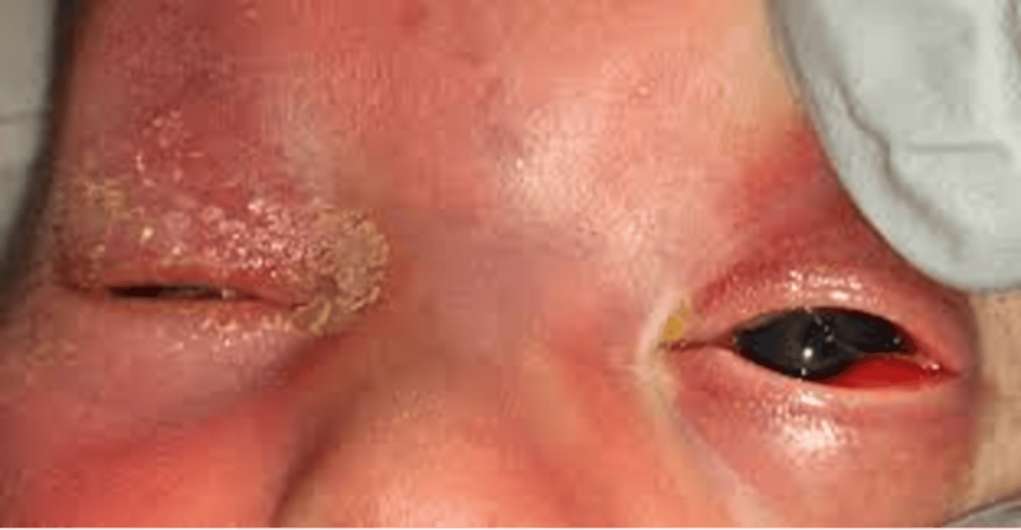<p>- bilateral conjunctivitis that appears btwn day 4-15 w minimal to severe discharge</p>