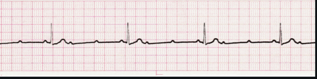 <p>ECG Intrepretation</p>